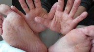 Qué es el virus Coxsackie y cómo se propaga: confirman más de 700 casos por brote en Puebla y Oaxaca