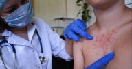 U.S. records highest number of measles cases since 1992, CDC says