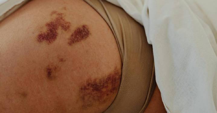 Moretones en el cuerpo: señales de advertencia que no debe ignorar, busque ayuda médica