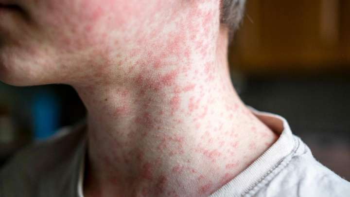 Pilbara measles outbreak: Community cluster rises to seven as WA Health urges people to get vaccinated