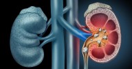 Shift Workers Face Higher Risk For Kidney Stones