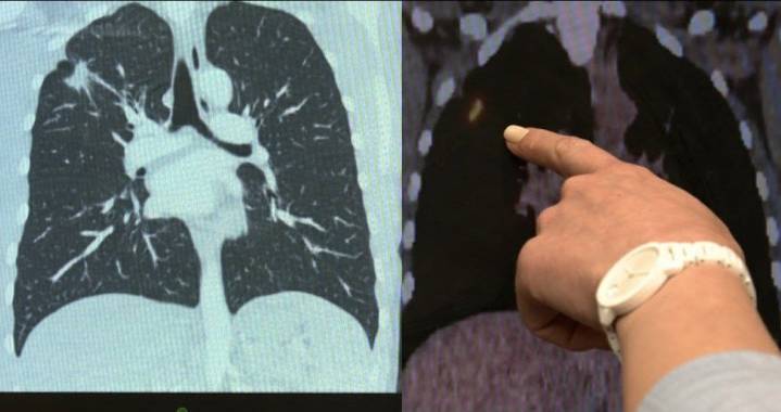 OSU Study: Lung cancer cases increasing in young, non