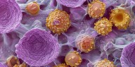 Una píldora podría prolongar la supervivencia entre los niños con un cáncer de huesos raro