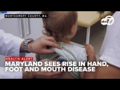 Maryland sees an increase in contagious hand, foot and mouth disease