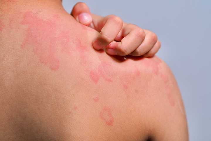 FDA Approves Chronic Spontaneous Urticaria Drug, Rhapsido