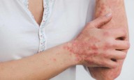 Psoriasis-linked gene mutation also impacts gut health: Study