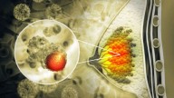 Rare and aggressive lobular breast cancer cases rising rapidly across the US