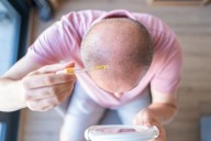 Tratamiento para la caída del cabello podría estar vinculado al suicidio, según nuevo estudio