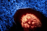 Oregon Health Authority Issues Measles Alert After Detection in Marion County Sewage