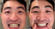 Prime Day shoppers snap up 'better than Amazon' £9 deal on teeth whitening solution