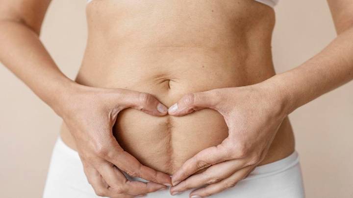 Diástasis: así es la patología que pueden provocar el estreñimiento, el peso o la tos