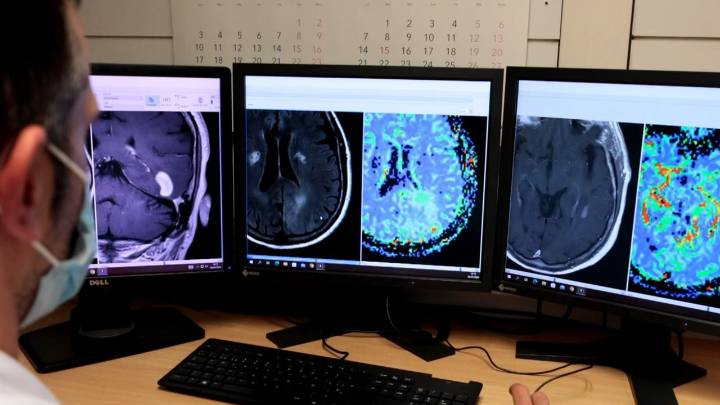 Hito en el párkinson: Observan por primera vez las proteínas consideradas como el origen de la enfermedad