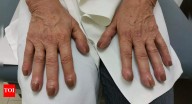 Lung cancer symptoms on fingers: Finger clubbing, nail changes and other warning signs that could indicate serious health risks