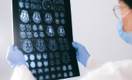 Hallazgo en epilepsia: siete metabolitos que predicen una crisis