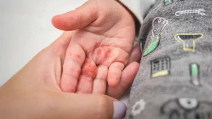 Alerta Salud por 144 casos de Coxsackie en escuelas de Hidalgo