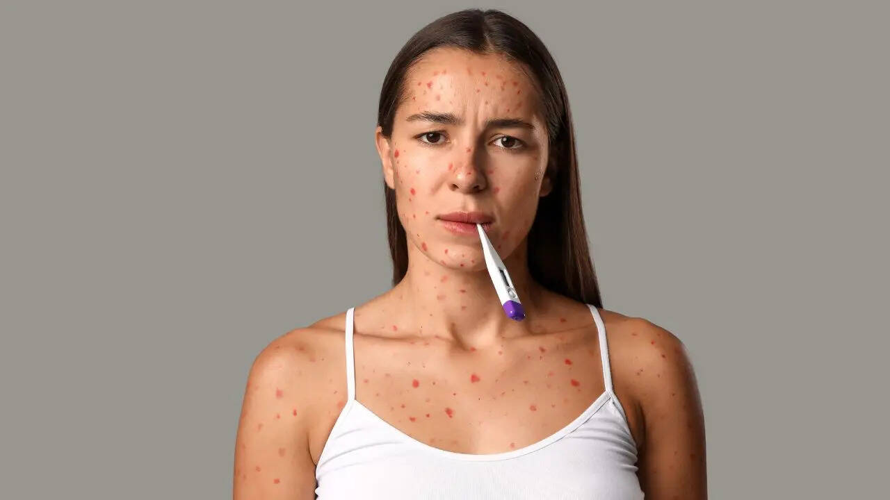 Symptoms of Mpox: New Strain Spreading In The UK Prompts Health Warning