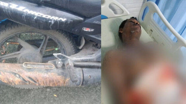Acid splashes from lorry; motorcyclist suffers severe burns in Kochi