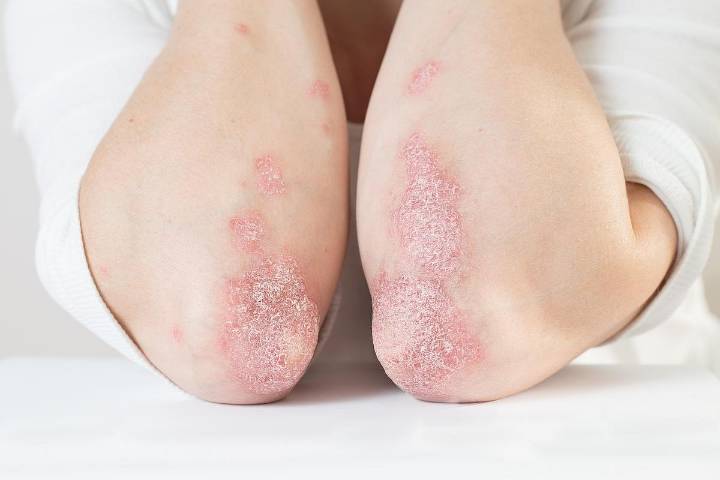 Incidence of Dermatologic Disease Persists in People With HIV