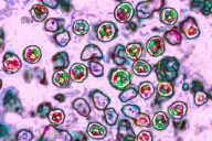 2 more measles cases confirmed in Spartanburg Co., reaching 25 total