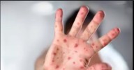 Brote de virus Coxsackie en Quintana Roo enciende alerta epidemiológica