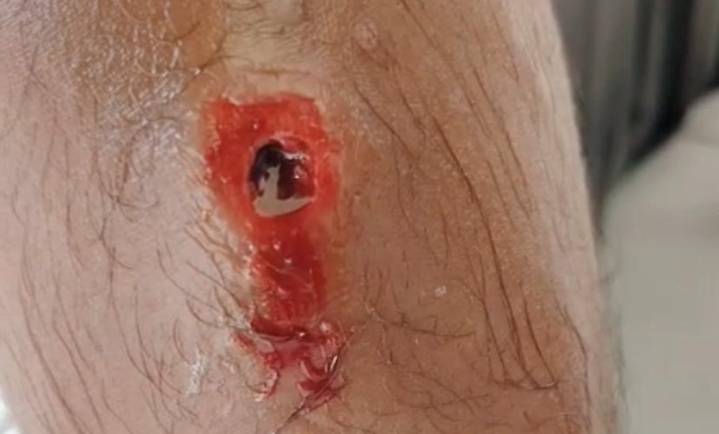 Cubano de la caravana es atendido en hospital de Chiapas por miasis