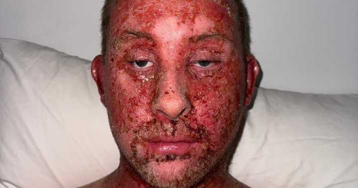 Man left with burning, oozing skin due to steroid cream withdrawal
