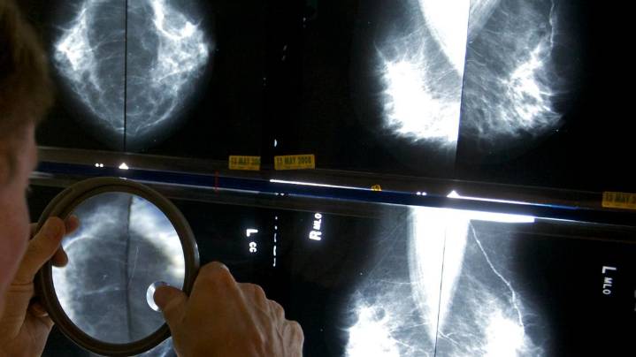 Early mammograms enhance breast cancer survival rates