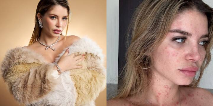 El valiente testimonio de Flavia Laos sobre la psoriasis y un poderoso mensaje de empatía a quienes la padecen