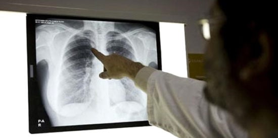 Sudáfrica: prueban con éxito nuevo tratamiento para la tuberculosis resistente a los medicamentos