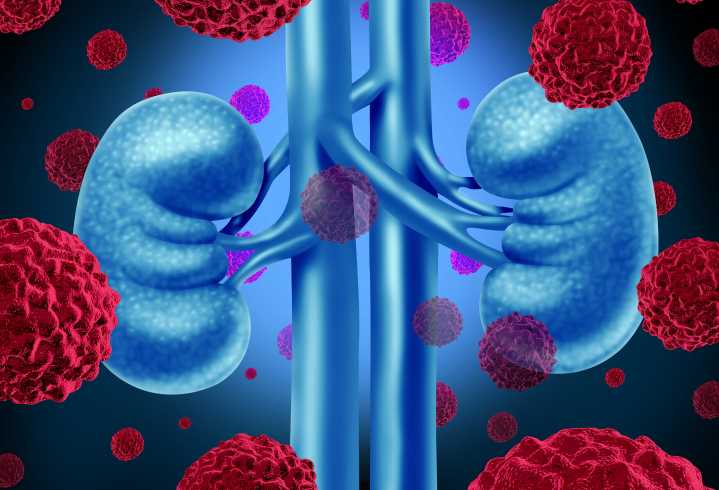 New Precision Target Found in Aggressive Kidney Cancer