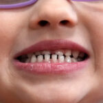 FDA restricts use of kids’ fluoride supplements citing emerging health risks