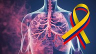 Este es el cáncer que más vidas cobra y sigue en aumento en América Latina. Así está la situación en Colombia