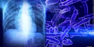 Testing available after 2 diagnosed with tuberculosis in New Hampshire