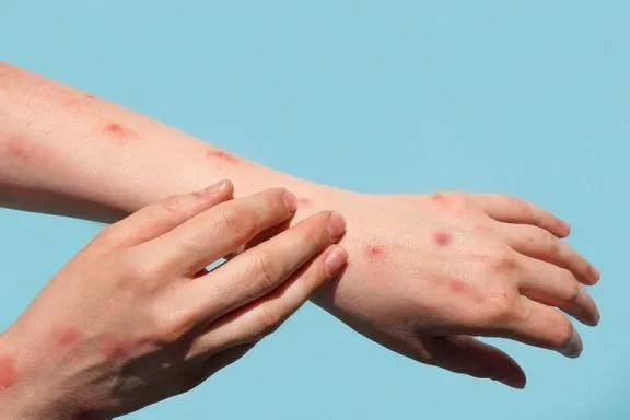Misiones refuerza controles y vacunación ante brote de sarampión en Paraguay