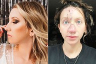 Dog Bites Woman's Nose 'Completely Off,' She Undergoes 4 Surgeries (Exclusive)