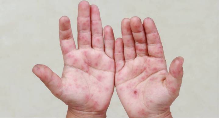 Descarta Salud alarma por virus Coxsackie en Nuevo León