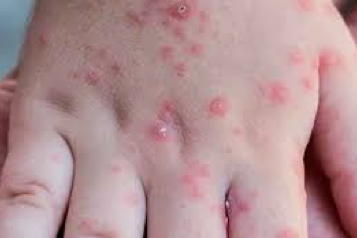 Reportan virus Coxsackie infecta a cientos de personas en Oaxaca