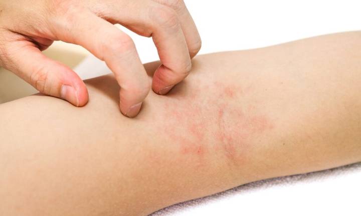 La dermatitis atópica afecta a uno de cada cinco niños en Venezuela