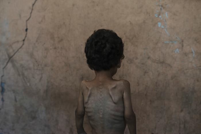 Nearly 55,000 children in Gaza under age 5 may be acutely malnourished, a new UN study finds
