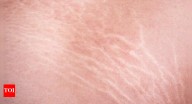 6 Effective tips to prevent stretch marks and improve skin elasticity