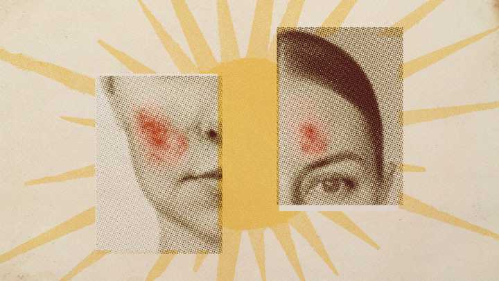 Skin is worsening because of climate change