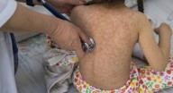 Sarampión en México, van más de 5 mil contagios y 23 muertes confirmadas