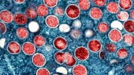 Officials confirm first US cases of more severe mpox strain with no travel history