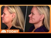 Cosmetic Surgery is Drawing Younger Patients and More Men