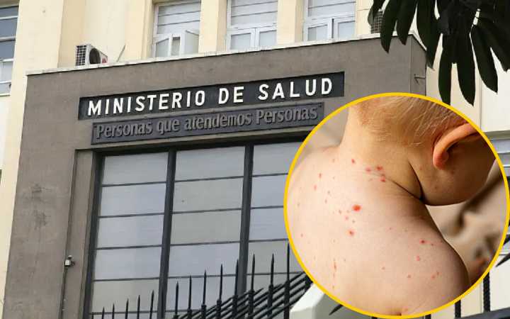 Minsa confirma nuevo caso de sarampión: Bebé de 11 meses fue diagnosticada tras viaje a Nueva Zelanda