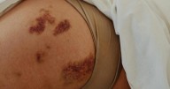 Moretones en el cuerpo: señales de advertencia que no debe ignorar, busque ayuda médica