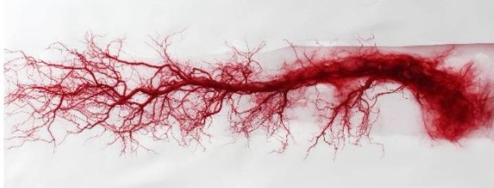 Estudio epigenético descubre claves sobre la arteritis de células gigantes