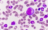 9/11 Dust Linked to Blood Mutations and Leukemia Risk