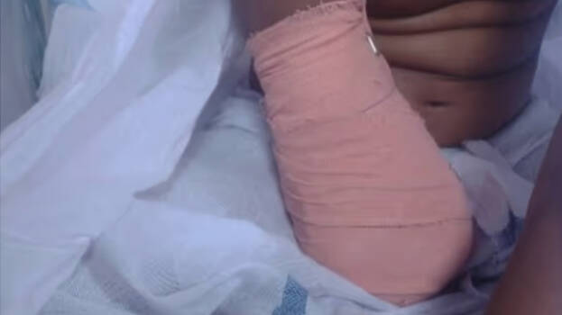 Wound and fracture: Eight-year-old girl's right arm amputated due to medical negligence