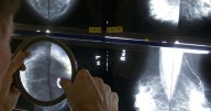 Detecting breast cancer in women with dense breast tissue